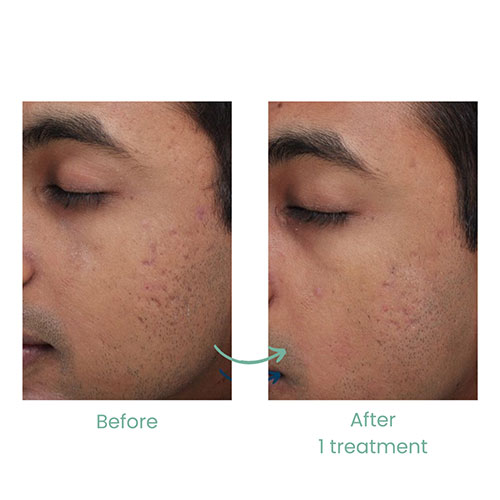 Results after 1 treatment Photos courtesy of Arizona Microneedling 4