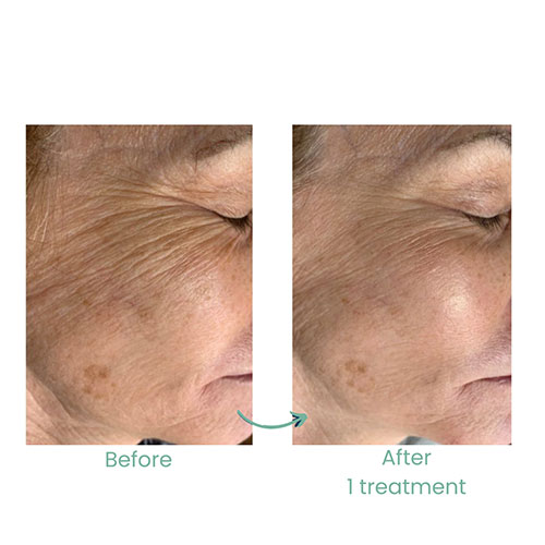 Results after 1 treatment Photos courtesy of Arizona Microneedling 5 1