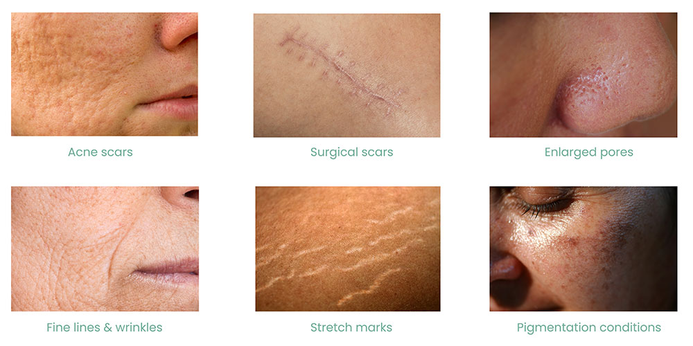 Results after 1 treatment Photos courtesy of Arizona Microneedling Banner Landscape